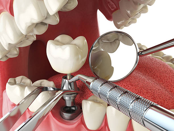 Best Emergency Treatment for Dental Infections or Abscesses in Ralston, NE
